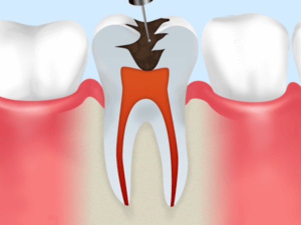 STEP1　歯髄の除去