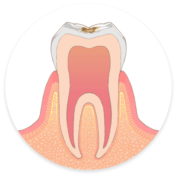 C1：エナメル質が溶けた状態歯