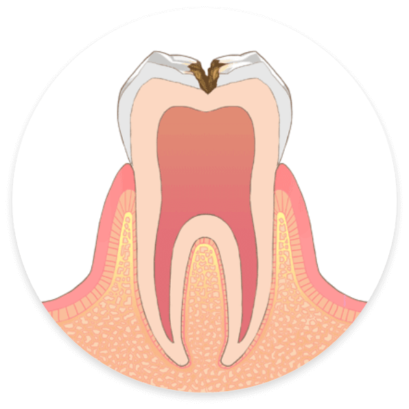 C2：象牙質まで虫歯が進行した状態
