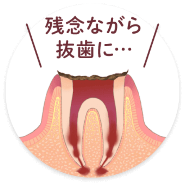 C4：歯の根に達した虫歯