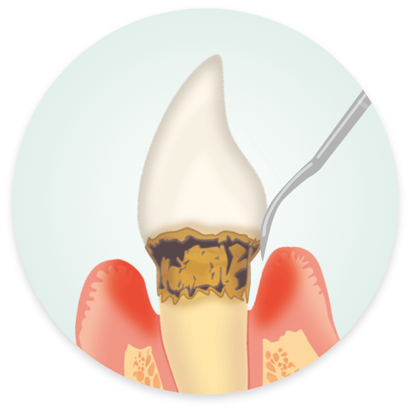 中等度の歯周病治療