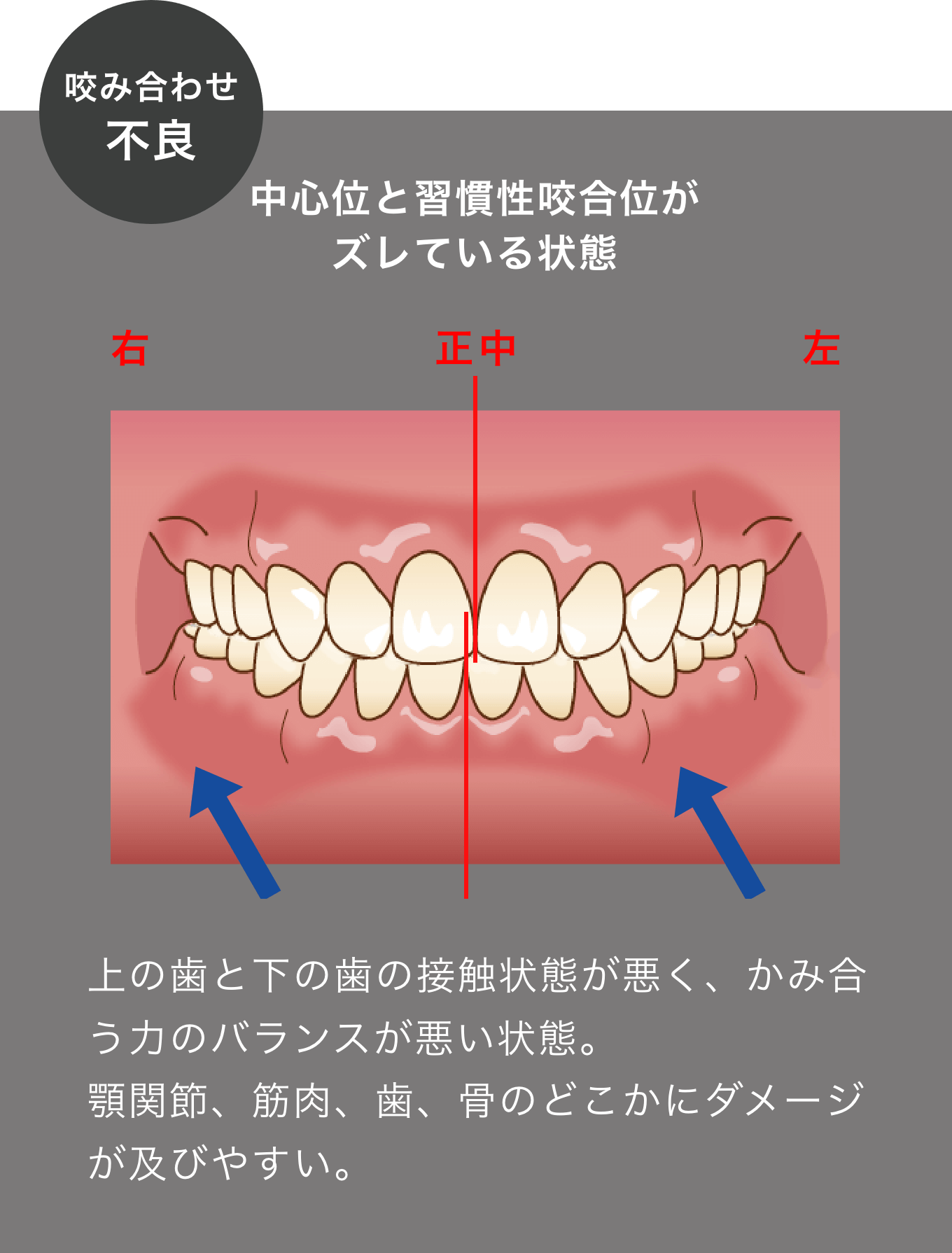 かみ合わせ不良