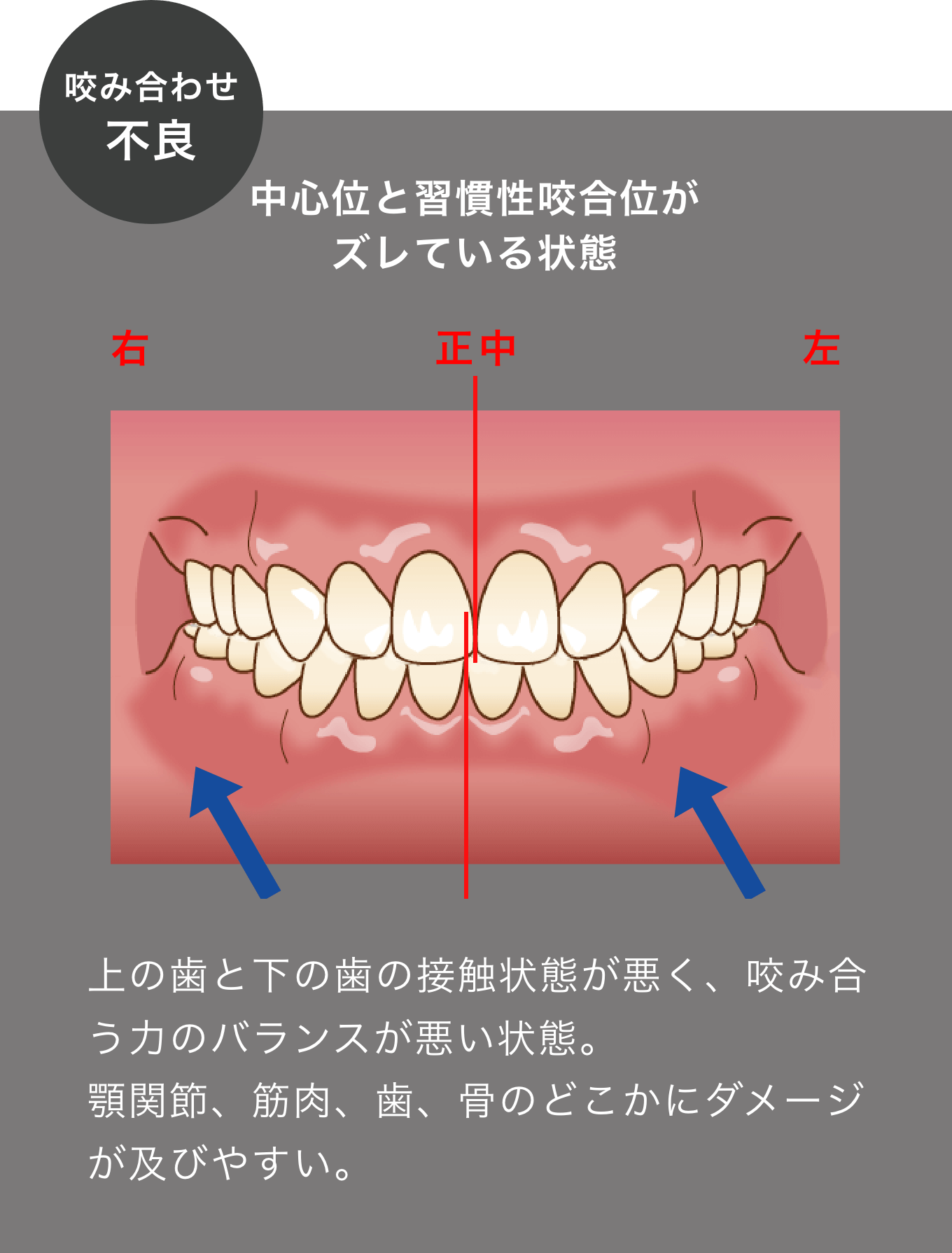 咬み合わせ不良