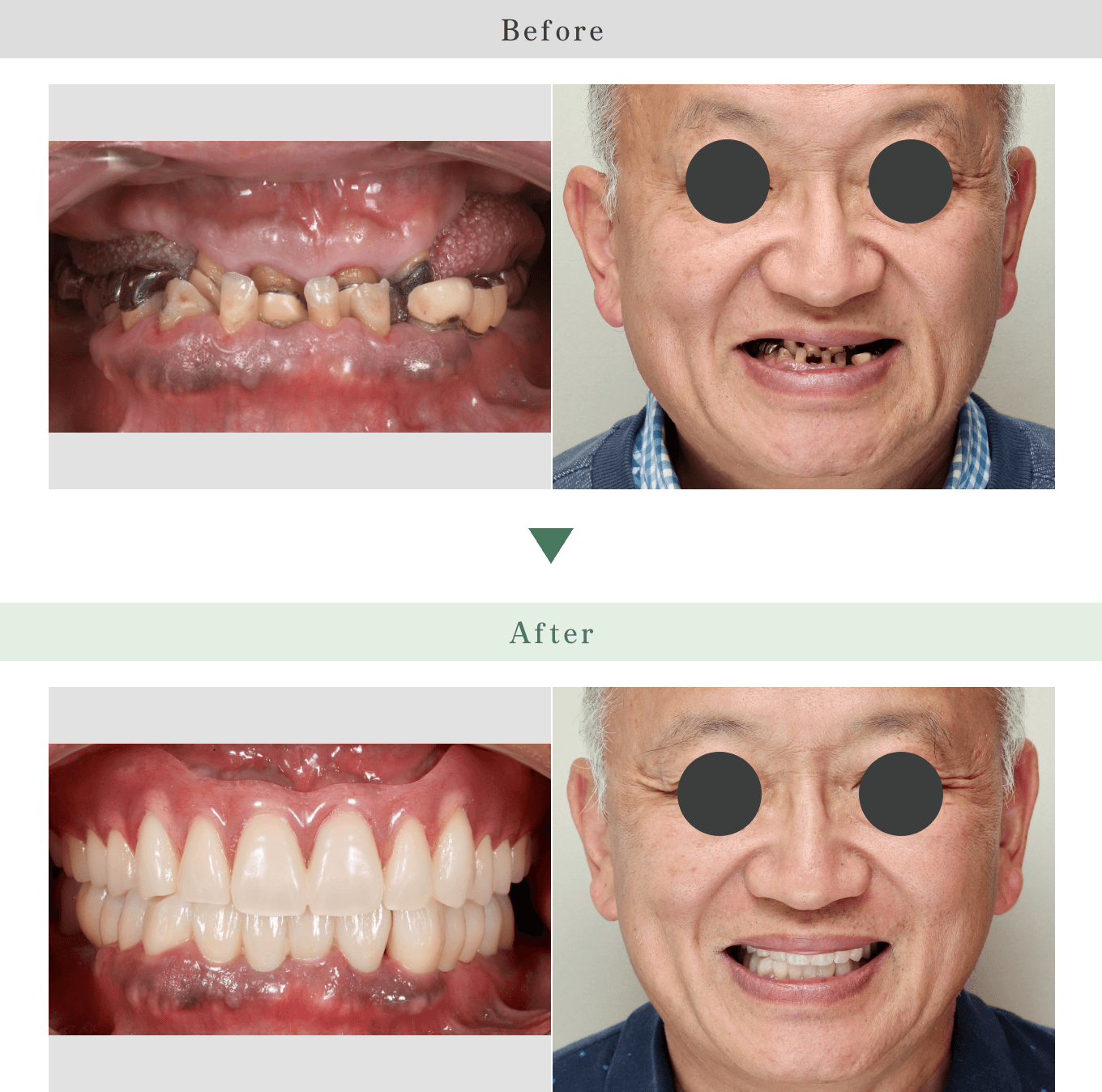 プロフェッショナルによる入れ歯・義歯治療 | たまプラーザの歯医者